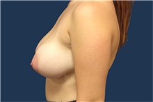 Breast Reduction Before Photo by Tommaso Addona, MD; Garden City, NY - Case 44858