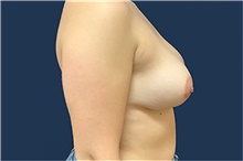 Breast Reduction After Photo by Tommaso Addona, MD; Garden City, NY - Case 44858
