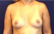 Breast Augmentation Before Photo by Tommaso Addona, MD; Garden City, NY - Case 44859