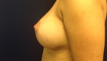Breast Augmentation After Photo by Tommaso Addona, MD; Garden City, NY - Case 44859