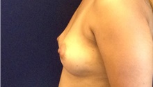 Breast Augmentation Before Photo by Tommaso Addona, MD; Garden City, NY - Case 44859