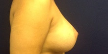 Breast Augmentation After Photo by Tommaso Addona, MD; Garden City, NY - Case 44859