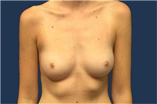Breast Augmentation Before Photo by Tommaso Addona, MD; Garden City, NY - Case 50611