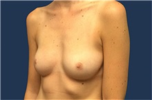 Breast Augmentation Before Photo by Tommaso Addona, MD; Garden City, NY - Case 50611