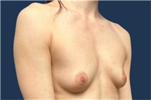 Breast Augmentation Before Photo by Tommaso Addona, MD; Garden City, NY - Case 50613