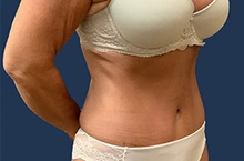 Tummy Tuck After Photo by Tommaso Addona, MD; Garden City, NY - Case 50609