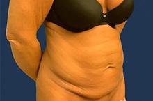 Tummy Tuck Before Photo by Tommaso Addona, MD; Garden City, NY - Case 50609