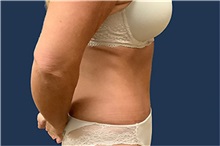 Tummy Tuck After Photo by Tommaso Addona, MD; Garden City, NY - Case 50609