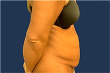 Tummy Tuck Before Photo by Tommaso Addona, MD; Garden City, NY - Case 50609