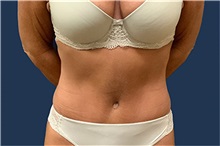 Tummy Tuck After Photo by Tommaso Addona, MD; Garden City, NY - Case 50609