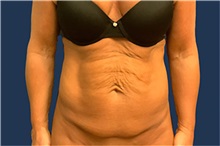 Tummy Tuck Before Photo by Tommaso Addona, MD; Garden City, NY - Case 50609