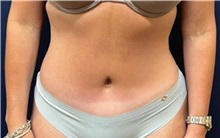 Tummy Tuck After Photo by Tommaso Addona, MD; Garden City, NY - Case 50614