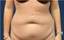 Tummy Tuck Before Photo by Tommaso Addona, MD; Garden City, NY - Case 50614