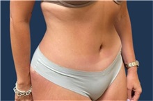 Tummy Tuck After Photo by Tommaso Addona, MD; Garden City, NY - Case 50614