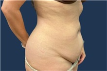 Tummy Tuck Before Photo by Tommaso Addona, MD; Garden City, NY - Case 50614