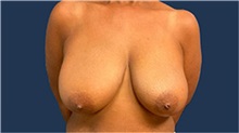 Breast Reduction Before Photo by Tommaso Addona, MD; Garden City, NY - Case 50615