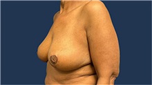 Breast Reduction After Photo by Tommaso Addona, MD; Garden City, NY - Case 50615