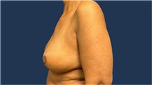 Breast Reduction After Photo by Tommaso Addona, MD; Garden City, NY - Case 50615