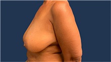 Breast Reduction Before Photo by Tommaso Addona, MD; Garden City, NY - Case 50615