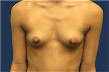 Breast Augmentation Before Photo by Tommaso Addona, MD; Garden City, NY - Case 50616