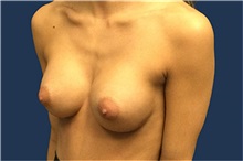 Breast Augmentation After Photo by Tommaso Addona, MD; Garden City, NY - Case 50616