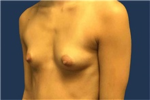 Breast Augmentation Before Photo by Tommaso Addona, MD; Garden City, NY - Case 50616