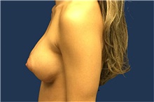 Breast Augmentation After Photo by Tommaso Addona, MD; Garden City, NY - Case 50616