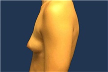 Breast Augmentation Before Photo by Tommaso Addona, MD; Garden City, NY - Case 50616