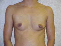 Breast Augmentation Before Photo by F. Nicholas Gahhos, MD; Venice, FL - Case 7093