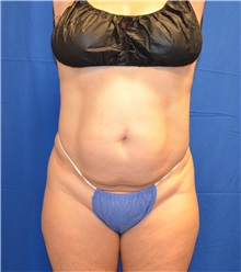 Liposuction Before Photo by Jon Ver Halen, MD; Southlake, TX - Case 32903