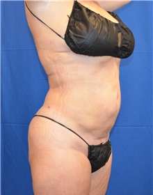 Liposuction After Photo by Jon Ver Halen, MD; Southlake, TX - Case 32903