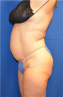 Liposuction Before Photo by Jon Ver Halen, MD; Southlake, TX - Case 32903