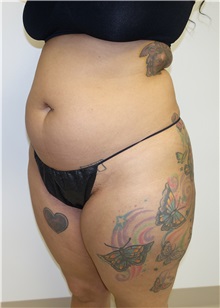 Liposuction Before Photo by Jon Ver Halen, MD; Southlake, TX - Case 33045