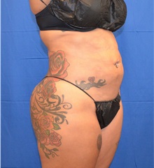 Liposuction After Photo by Jon Ver Halen, MD; Southlake, TX - Case 33045