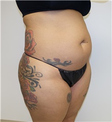 Liposuction Before Photo by Jon Ver Halen, MD; Southlake, TX - Case 33045