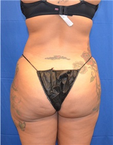 Liposuction After Photo by Jon Ver Halen, MD; Southlake, TX - Case 33045