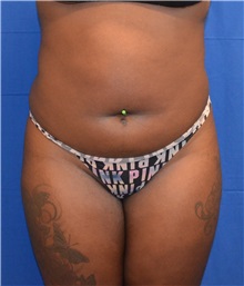 Liposuction Before Photo by Jon Ver Halen, MD; Southlake, TX - Case 33256