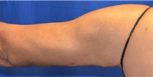 Arm Lift After Photo by Jon Ver Halen, MD; Southlake, TX - Case 33487