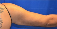 Arm Lift After Photo by Jon Ver Halen, MD; Southlake, TX - Case 33487