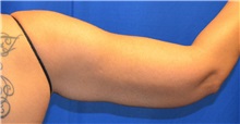 Arm Lift Before Photo by Jon Ver Halen, MD; Southlake, TX - Case 33487