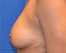 Breast Lift After Photo by Jon Ver Halen, MD; Southlake, TX - Case 33543