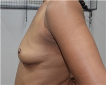 Breast Lift Before Photo by Jon Ver Halen, MD; Southlake, TX - Case 33543