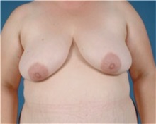 Breast Lift Before Photo by Jon Ver Halen, MD; Southlake, TX - Case 33544