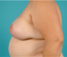Breast Lift After Photo by Jon Ver Halen, MD; Southlake, TX - Case 33544