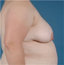 Breast Lift Before Photo by Jon Ver Halen, MD; Southlake, TX - Case 33544