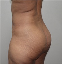 Buttock Lift with Augmentation Before Photo by Jon Ver Halen, MD; Southlake, TX - Case 33667
