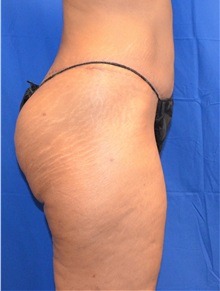 Buttock Lift with Augmentation After Photo by Jon Ver Halen, MD; Southlake, TX - Case 33667