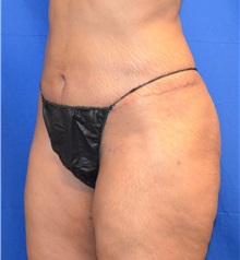 Liposuction After Photo by Jon Ver Halen, MD; Southlake, TX - Case 33717