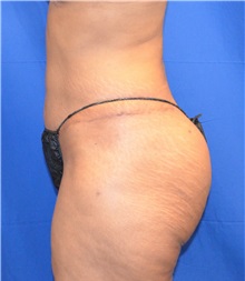 Liposuction After Photo by Jon Ver Halen, MD; Southlake, TX - Case 33717