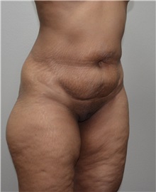 Liposuction Before Photo by Jon Ver Halen, MD; Southlake, TX - Case 33717